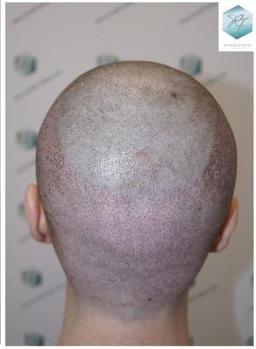 Injerto Capilar Técnica FUE 3124 Grafts (8727 Pelos) 14 injerto pelo en españa