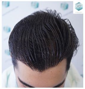 Injerto Capilar Técnica FUE 3105 Grafts (7493 Pelos) 16 resultado trasplante de pelo