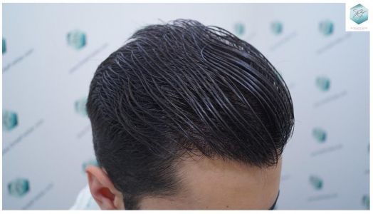 Injerto Capilar Técnica FUE 3105 Grafts (7493 Pelos) 20 resultado trasplante de pelo