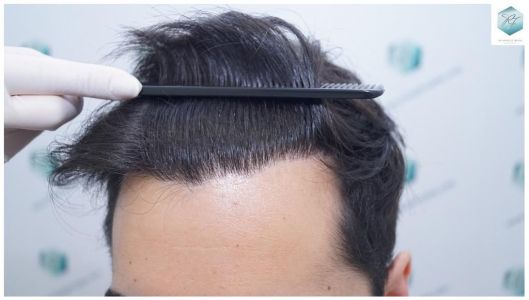 Injerto Capilar Técnica FUE 3105 Grafts (7493 Pelos) 26 resultado trasplante de pelo