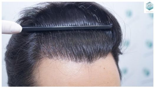 Injerto Capilar Técnica FUE 3105 Grafts (7493 Pelos) 23 resultado trasplante de pelo
