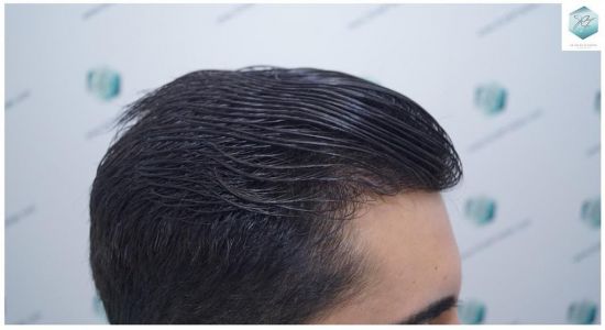 Injerto Capilar Técnica FUE 3105 Grafts (7493 Pelos) 19 resultado trasplante de pelo