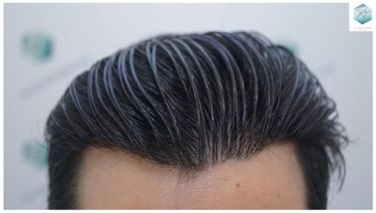 Injerto Capilar Técnica FUE 3105 Grafts (7493 Pelos) 18 resultado trasplante de pelo