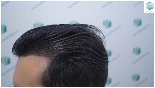 Injerto Capilar Técnica FUE 3105 Grafts (7493 Pelos) 24 resultado trasplante de pelo