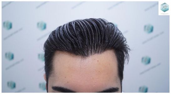 Injerto Capilar Técnica FUE 3105 Grafts (7493 Pelos) 15 resultado trasplante de pelo