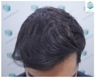 Injerto Capilar Técnica FUE 3105 Grafts (7493 Pelos) 17 resultado trasplante de pelo