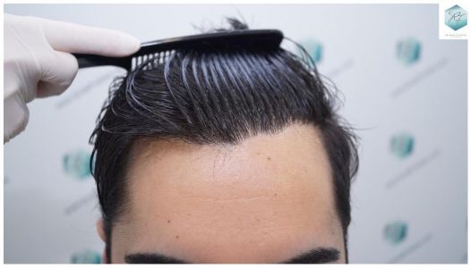Injerto Capilar Técnica FUE 3105 Grafts (7493 Pelos) 22 resultado trasplante de pelo