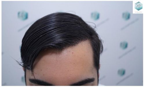 Injerto Capilar Técnica FUE 3105 Grafts (7493 Pelos) 27 resultado trasplante de pelo