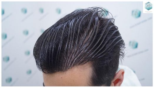 Injerto Capilar Técnica FUE 3105 Grafts (7493 Pelos) 25 resultado trasplante de pelo
