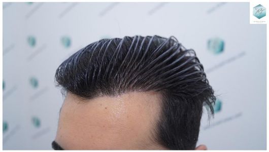 Injerto Capilar Técnica FUE 3105 Grafts (7493 Pelos) 21 resultado trasplante de pelo