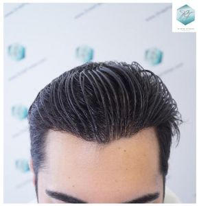 RESULTADOS A LOS 12 MESES resultado trasplante de pelo