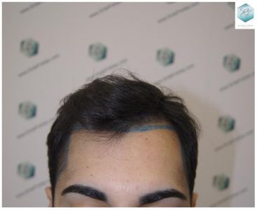 ANTES TRASPLANTE CAPILAR resultado trasplante de pelo