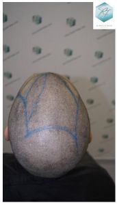 Injerto Capilar Técnica FUE 3105 Grafts (7493 Pelos) 7 resultado trasplante de pelo