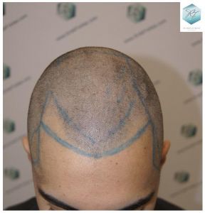Injerto Capilar Técnica FUE 3105 Grafts (7493 Pelos) 5 resultado trasplante de pelo