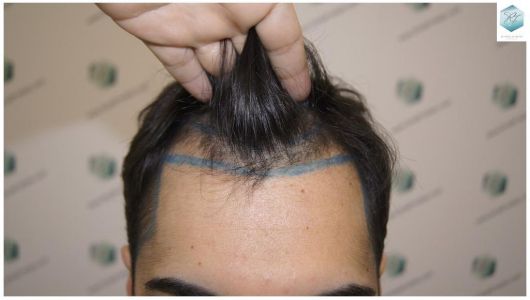 Injerto Capilar Técnica FUE 3105 Grafts (7493 Pelos) 1 resultado trasplante de pelo