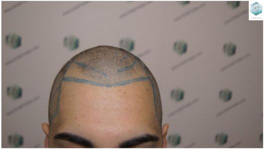 Injerto Capilar Técnica FUE 3105 Grafts (7493 Pelos) 6 resultado trasplante de pelo