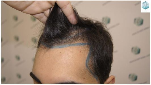Injerto Capilar Técnica FUE 3105 Grafts (7493 Pelos) 4 resultado trasplante de pelo