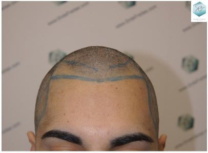 DISEÑO LINEA INJERTO resultado trasplante de pelo