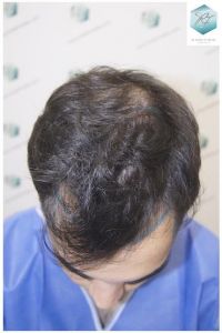 Injerto Capilar Técnica FUE 3105 Grafts (7493 Pelos) 2 resultado trasplante de pelo