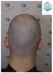 Injerto Capilar Técnica FUE 3105 Grafts (7493 Pelos) 28 resultado trasplante de pelo