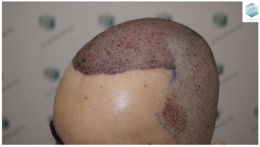Injerto Capilar Técnica FUE 3105 Grafts (7493 Pelos) 13 resultado trasplante de pelo