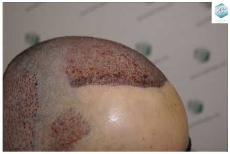 Injerto Capilar Técnica FUE 3105 Grafts (7493 Pelos) 10 resultado trasplante de pelo
