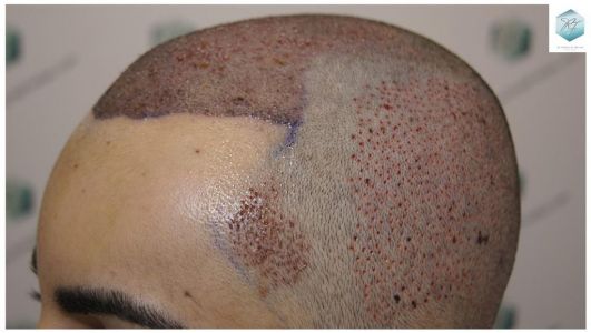 Injerto Capilar Técnica FUE 3105 Grafts (7493 Pelos) 12 resultado trasplante de pelo
