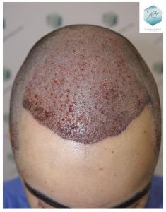 Injerto Capilar Técnica FUE 3105 Grafts (7493 Pelos) 8 resultado trasplante de pelo