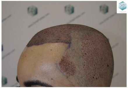Injerto Capilar Técnica FUE 3105 Grafts (7493 Pelos) 11 resultado trasplante de pelo