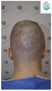 Injerto Capilar Técnica FUE 3105 Grafts (7493 Pelos) 14 resultado trasplante de pelo