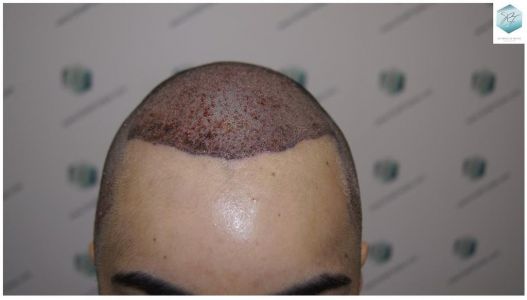TRASPLANTE CAPILAR resultado trasplante de pelo