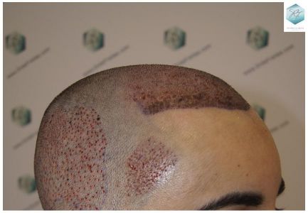 Injerto Capilar Técnica FUE 3105 Grafts (7493 Pelos) 9 resultado trasplante de pelo