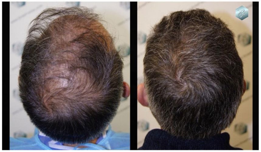 Injerto Capilar Técnica FUE 3180 Grafts (7446 Pelos) 15 ANTES-Y-DESPUES-TRASPLANTE-CAPILAR