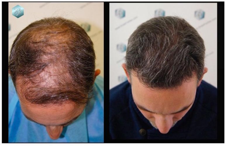 COMPARATIVAS ANTES-Y-DESPUES-TRASPLANTE-CAPILAR