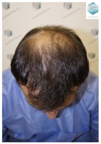 Injerto Capilar Técnica FUE 2036 Grafts (4761 Pelos) 1 trasplante de pelo valencia