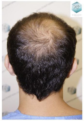 Injerto Capilar Técnica FUE 2036 Grafts (4761 Pelos) 6 trasplante de pelo valencia