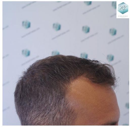 Injerto Capilar Técnica FUE 2036 Grafts (4761 Pelos) 14 trasplante de pelo valencia