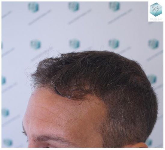 Injerto Capilar Técnica FUE 2036 Grafts (4761 Pelos) 15 trasplante de pelo valencia