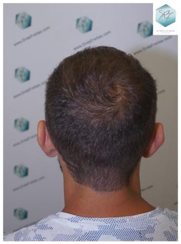Injerto Capilar Técnica FUE 2036 Grafts (4761 Pelos) 18 trasplante de pelo valencia