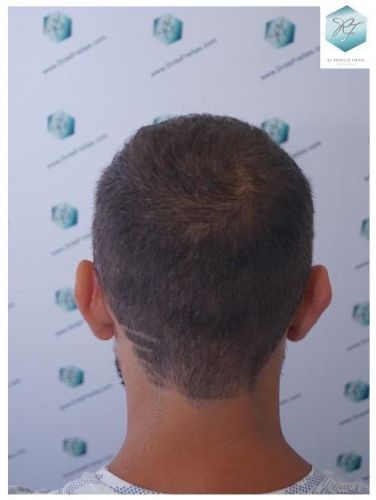 Injerto Capilar Técnica FUE 2036 Grafts (4761 Pelos) 17 trasplante de pelo valencia