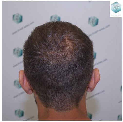 Injerto Capilar Técnica FUE 2036 Grafts (4761 Pelos) 16 trasplante de pelo valencia