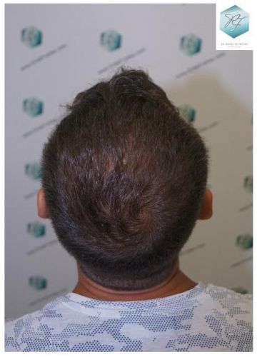 RESULTADOS A LOS 12 MESES trasplante de pelo valencia