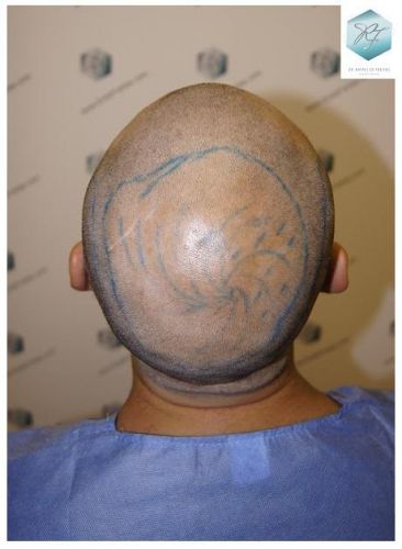 Injerto Capilar Técnica FUE 2036 Grafts (4761 Pelos) 8 trasplante de pelo valencia