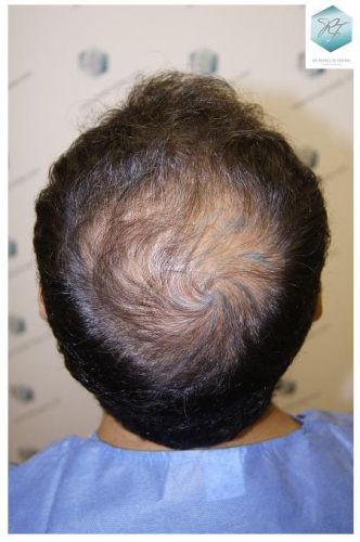 Injerto Capilar Técnica FUE 2036 Grafts (4761 Pelos) 4 trasplante de pelo valencia