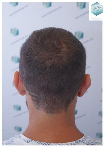 Injerto Capilar Técnica FUE 2036 Grafts (4761 Pelos) 19 trasplante de pelo valencia