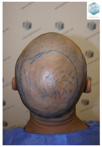 Injerto Capilar Técnica FUE 2036 Grafts (4761 Pelos) 7 trasplante de pelo valencia