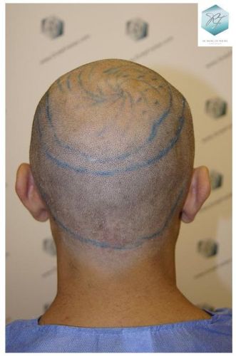 LINEA DISEÑO CAPILAR trasplante de pelo valencia