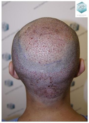 Injerto Capilar Técnica FUE 2036 Grafts (4761 Pelos) 13 trasplante de pelo valencia