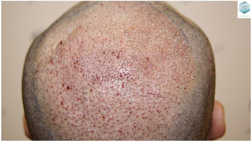 Injerto Capilar Técnica FUE 2036 Grafts (4761 Pelos) 10 trasplante de pelo valencia