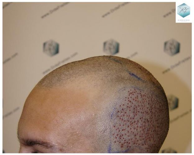 Injerto Capilar Técnica FUE 2036 Grafts (4761 Pelos) 12 trasplante de pelo valencia